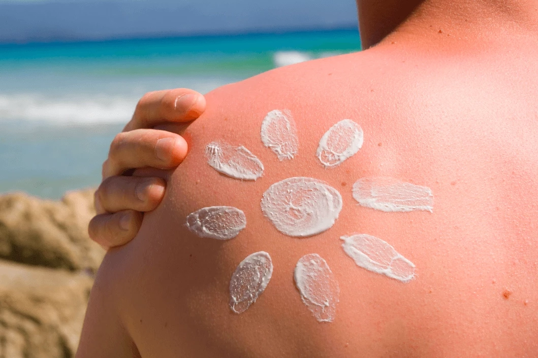 Güneş yanığına dikkat!